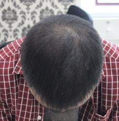 -大麦微针植发全国连锁