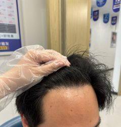 体验后-大麦微针植发丨全国连锁