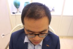 -大麦微针植发丨全国连锁