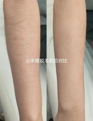 -薇兰专业脱毛连锁机构