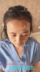 点击看大图 -大麦微针植发丨全国连锁