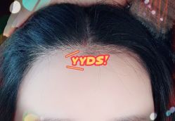 -大麦微针植发全国连锁