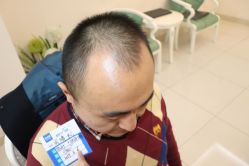 -大麦微针植发丨全国连锁