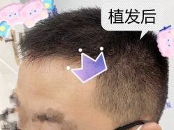 -大麦微针植发全国连锁