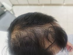 -碧莲盛·不剃发植发