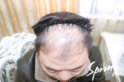 点击看大图 体验后-大麦微针植发全国连锁