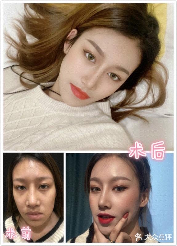 面露凶相？你该来几支玻尿酸！