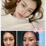 面露凶相？你该来几支玻尿酸！