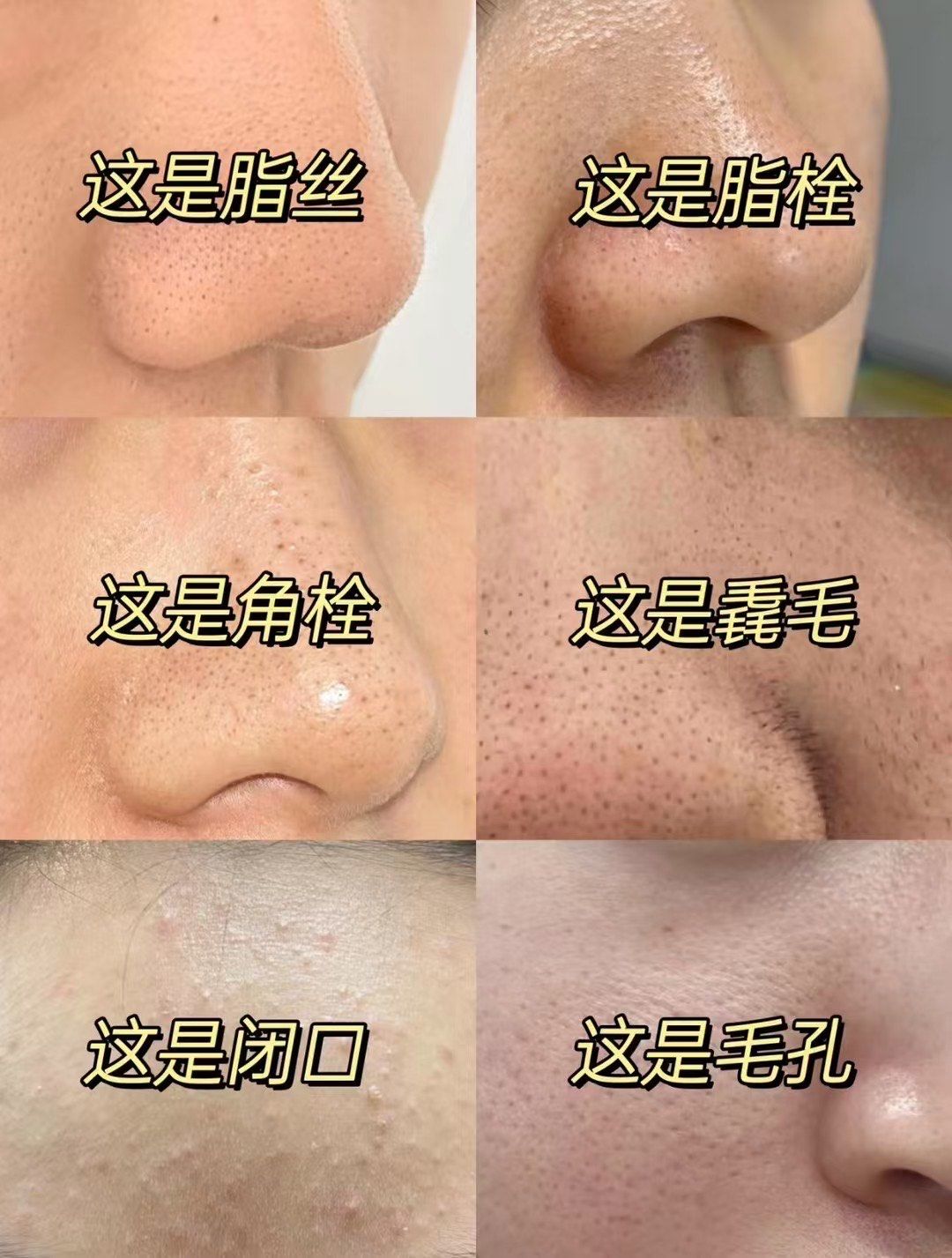 如何轻松告别毛孔堵塞