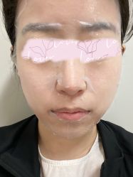 体验后-叶美人医疗美容