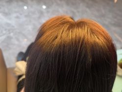 -碧莲盛·不剃发植发