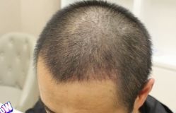 -大麦微针植发丨全国连锁