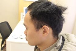-大麦微针植发丨全国连锁