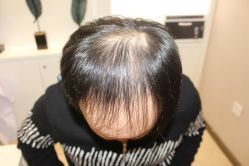 点击看大图 -大麦微针植发丨全国连锁