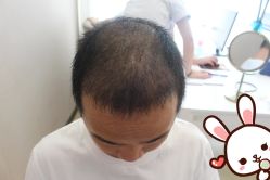 点击看大图 -大麦微针植发丨全国连锁