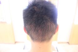 点击看大图 -大麦微针植发丨全国连锁