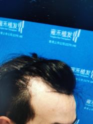 体验前-雍禾植发全国连锁