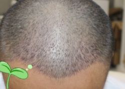 -大麦微针植发丨全国连锁