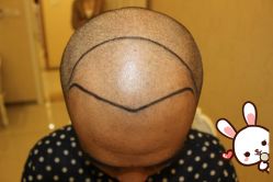 点击看大图 -大麦微针植发丨全国连锁