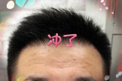 -大麦微针植发全国连锁