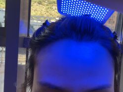 -碧莲盛·不剃发植发