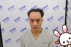 点击看大图 -大麦微针植发丨全国连锁