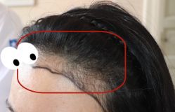 -大麦微针植发全国连锁