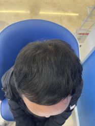 -大麦微针植发全国连锁