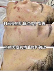 -美肤盾祛痘·问题肌头疗管理中心