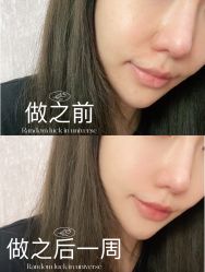 体验前-广州健丽·去眼袋医疗美容机构