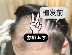 -大麦微针植发全国连锁