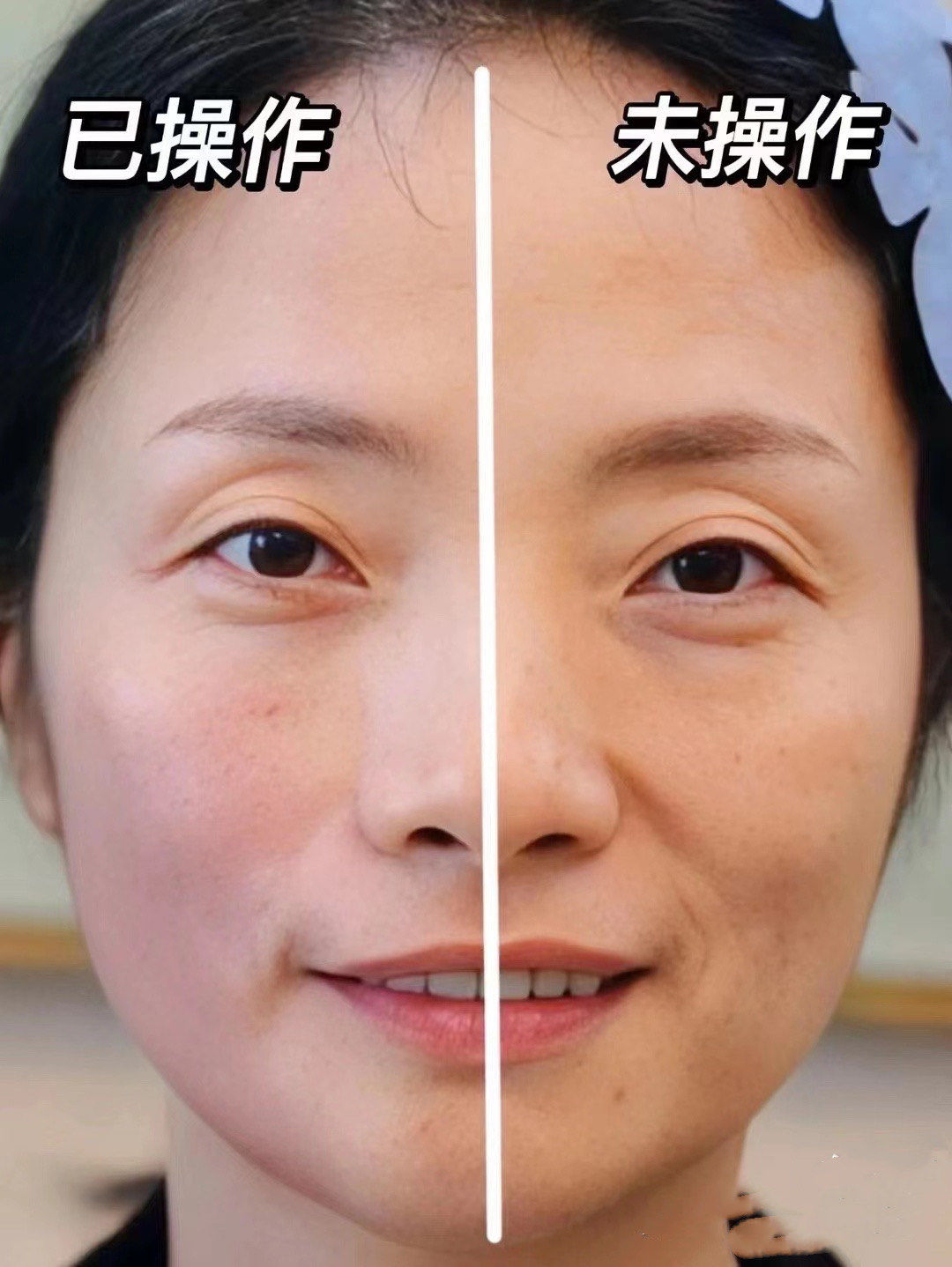 徒手整形,整出来的脸就这么自然.