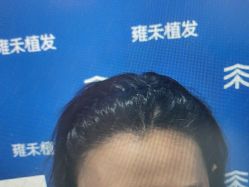 -雍禾植发全国连锁