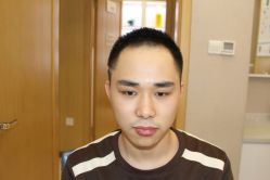 -大麦微针植发丨全国连锁