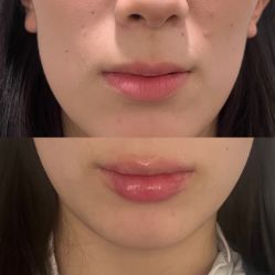 -海涛医疗美容·面部抗衰·注射美鼻