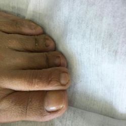 点击看大图 -德哥灰指甲脚气甲沟炎跖疣护理
