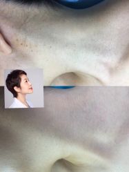 -美丽人生祛斑扁平疣汗管瘤中心