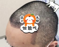 -大麦微针植发全国连锁