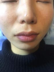 -爱莎扁平疣·汗管瘤·斑痣中心