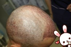 -大麦微针植发丨全国连锁