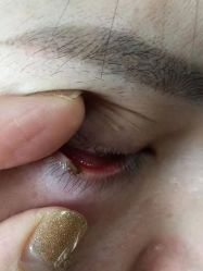 -北京美痣堂古方祛痣斑疣瘊