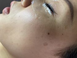体验前-爱莎扁平疣·汗管瘤·斑痣中心