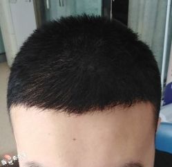 -大麦微针植发丨全国连锁