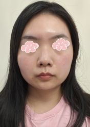 体验后-苏亚医美·高端注射明星整形机构