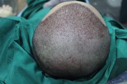 点击看大图 -大麦微针植发丨全国连锁