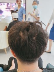 -大麦微针植发全国连锁