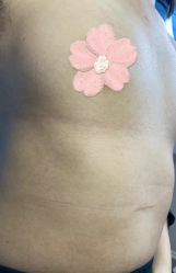 -美丽人生祛斑扁平疣汗管瘤中心
