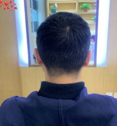 -大麦微针植发丨全国连锁