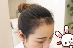 点击看大图 -大麦微针植发丨全国连锁