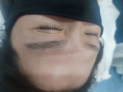 体验后-郡艺医疗美容·微整·眼鼻吸脂